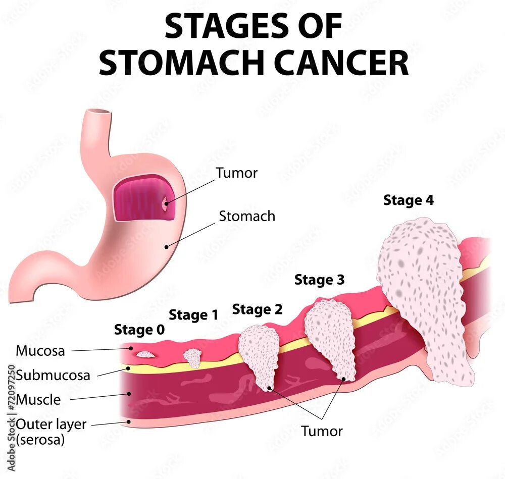 Рак желудка симптомы фото Staging of stomach cancer Векторный объект Stock Adobe Stock