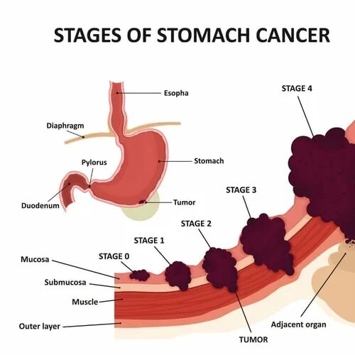 Рак желудка стадия фото An Overview of Stomach Cancer Oregon's GI Cancer Specialists