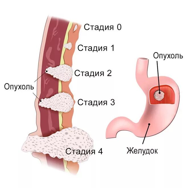 Рак желудка стадия фото Полезная информация на сайте Отдела абдоминальной онкологии при ПСПБГМУ им. акад