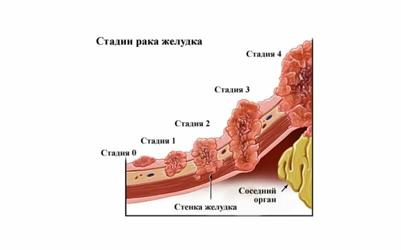 Рак желудка стадия фото Стадии рака TNM классификация