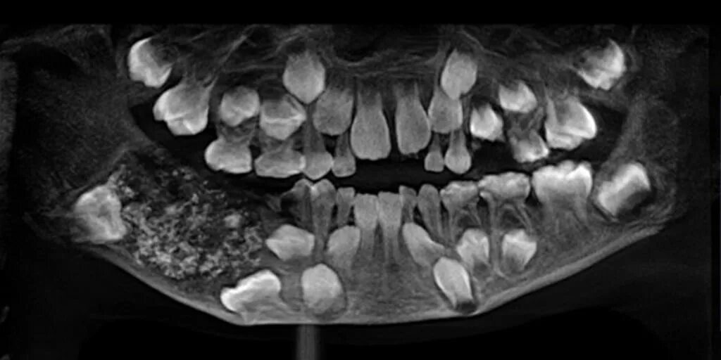 Рак зуба фото Doctors remove 526 'tooth-like structures' from 7-year-old boy's mouth