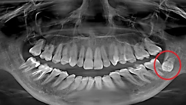 Рак зуба фото Аномалия прорезывания зуба Второе мнение