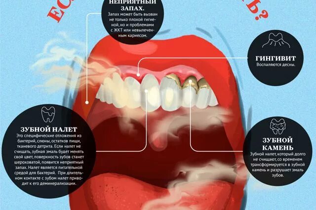 Рак зуба фото Что будет с зубами, если их не чистить? Инфографика Аргументы и Факты