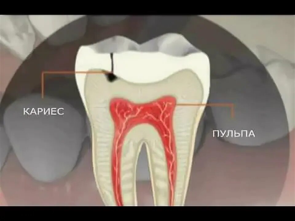 Рак зуба симптомы фото Лечение кариеса без депульпации - YouTube