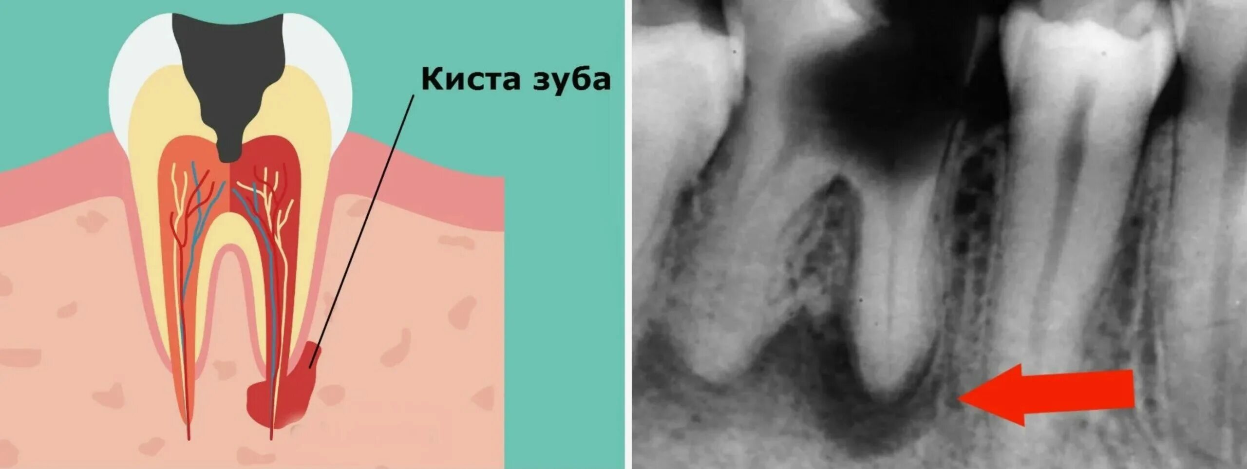 Рак зуба симптомы фото и лечение Киста зуба под коронкой - Cтоматология Май