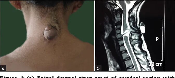 Раковая опухоль фото снаружи Figure 4 from Spinal dorsal dermal sinus tract: An experience of 21 cases Semant