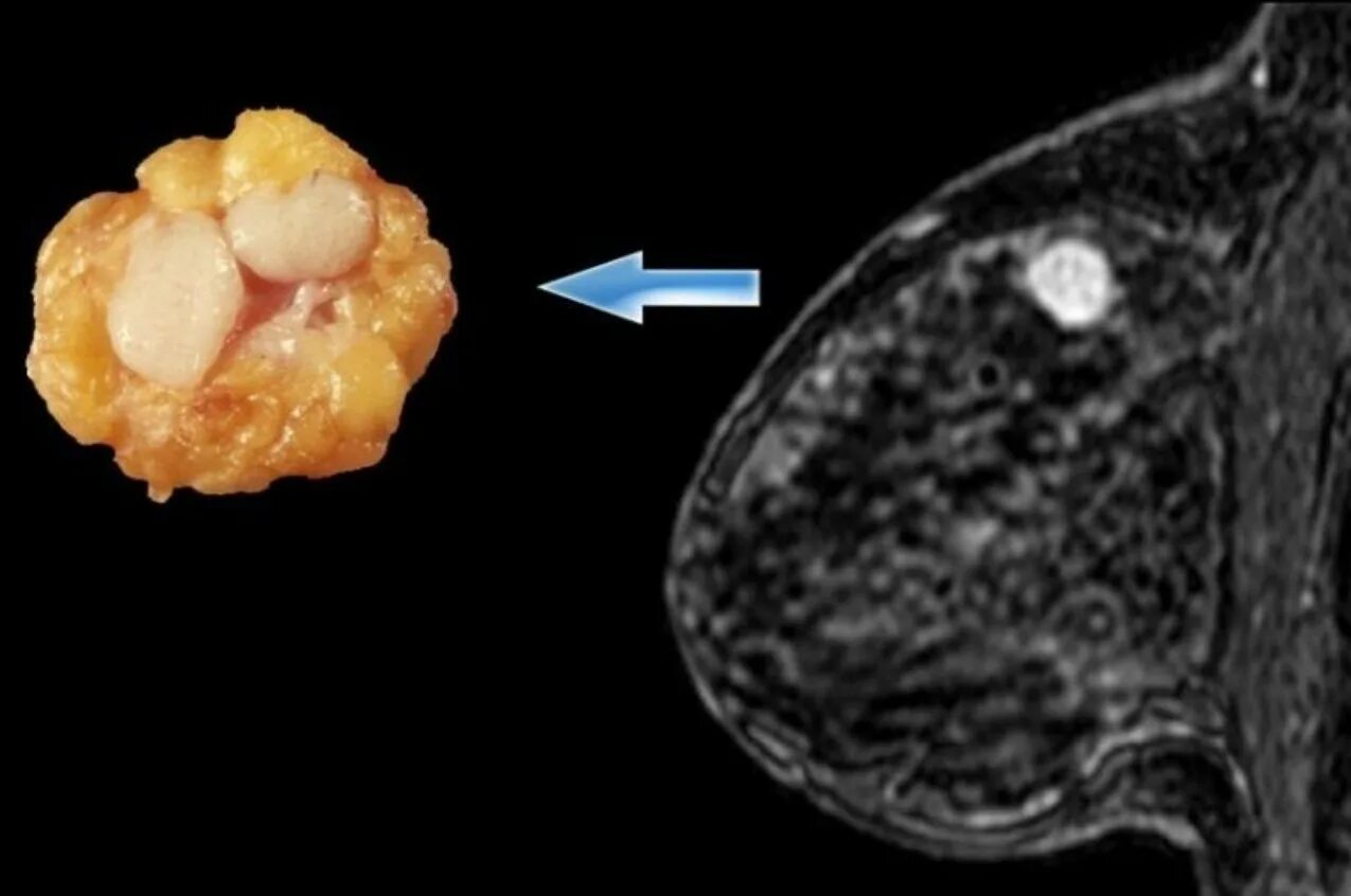 Раковая опухоль фото снаружи Фиброаденома молочной железы лечение в Улан-Удэ