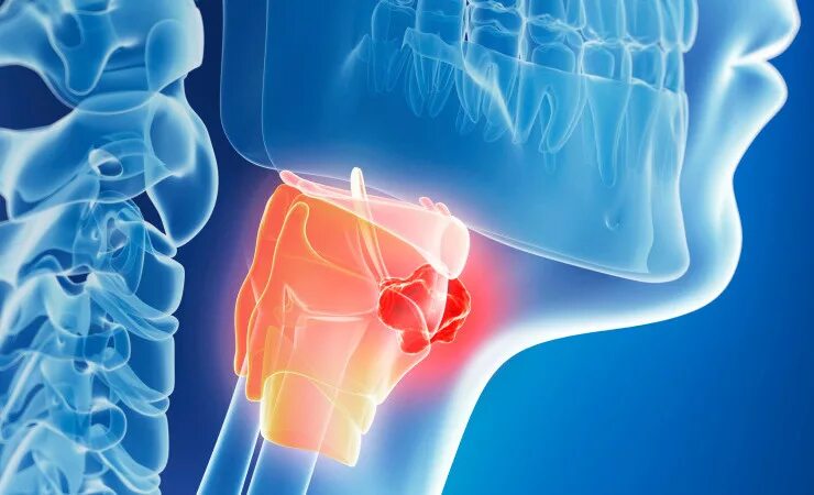 Раковая опухоль горла фото Ранние признаки рака горла - причины и симптомы опухоли