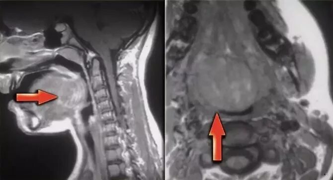 Раковая опухоль горла фото МРТ горла и гортани, когда сделать МРТ или КТ гортани, покажет ли МРТ горла пище