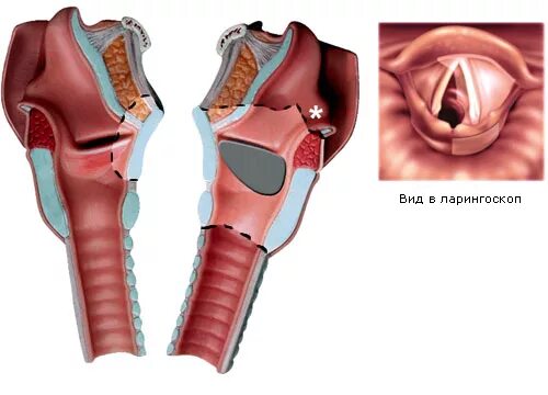 Раковая опухоль горла фото Опухоль гортани - Онкология - Болезни - MedClub.ru