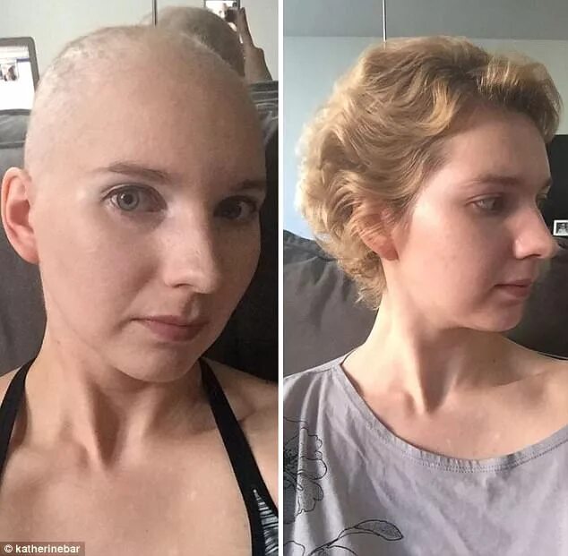 Раковые больные фото до и после Cancer survivors post transformation photos on Bored Panda Daily Mail Online