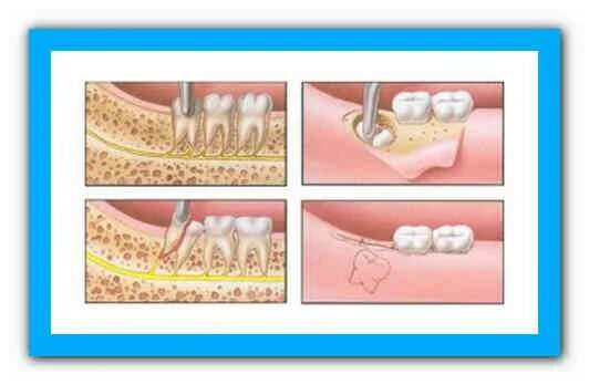 Рана после удаления зуба фото Интервью Зуба мудрости после удаления - опыт пациента и советы по реабилитации М
