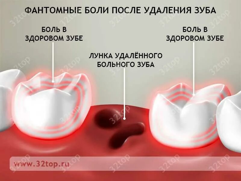 Рана после удаления зуба фото Через сколько убрать вату после удаления зуба