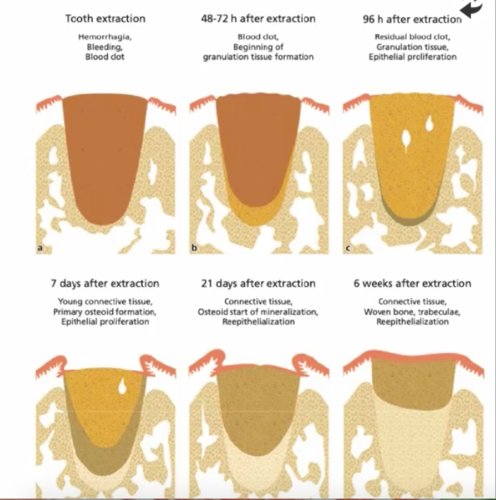 Рана после удаления зуба мудрости фото Alveolar Ridge Preservation and Immediate Implant Placement (Biologic and Surgic