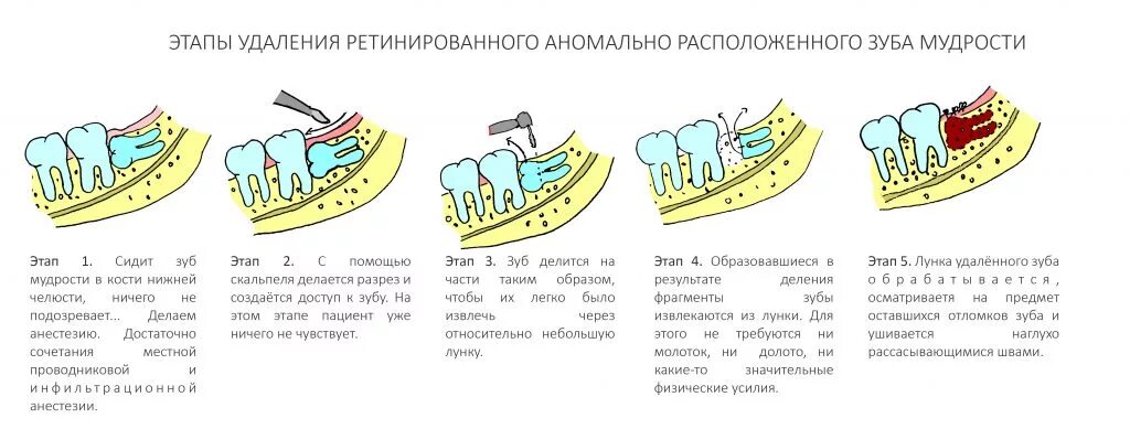 Рана после удаления зуба мудрости фото Удаление зубов мудрости. Как это делается? - CLINICIN.RU