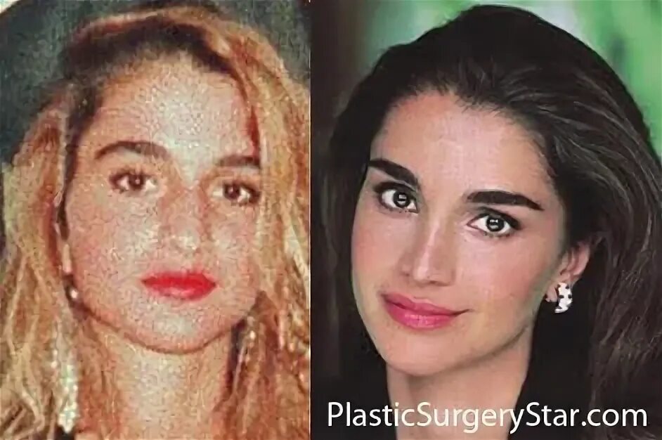 Рания до пластики фото To many people's surprise, Queen Rania had a nose job. The plastic surgery reduc