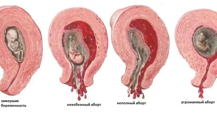 Ранних стадиях у женщин фото Новая беременность после прерывания беременности или выкидыша: когда и как? О де