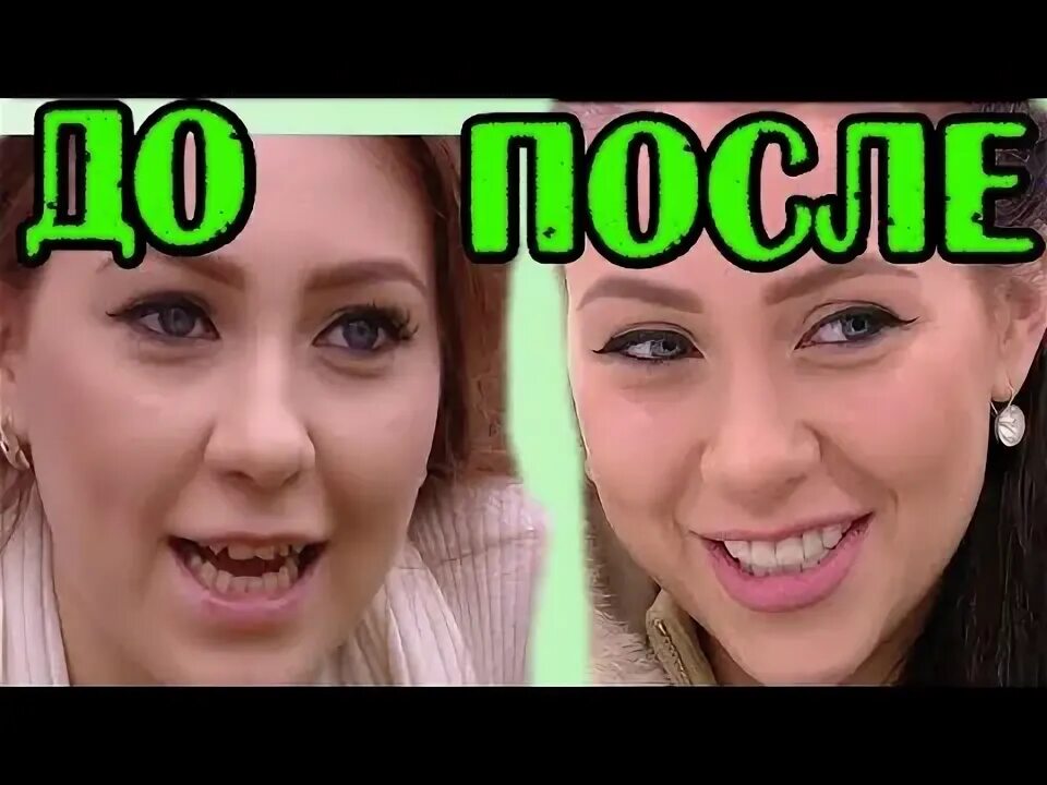 Рапунцель до и после пластики фото АЛЁНА РАПУНЦЕЛЬ ДО И ПОСЛЕ ПЛАСТИКИ! - YouTube