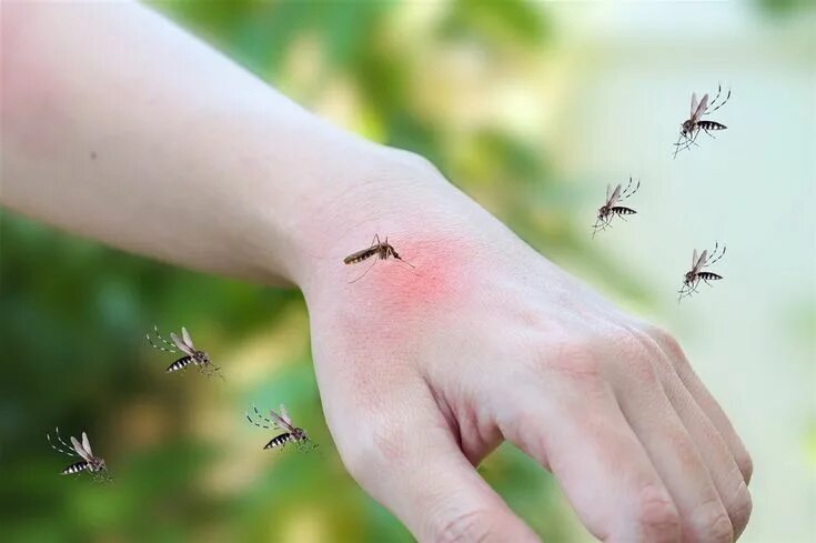 Расчесанный укус комара фото Descubren por qué algunos mosquitos prefieren a los humanos Como eliminar mosqui