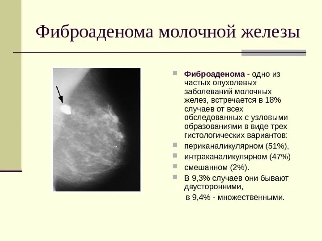 Распад опухоли молочной железы 4 стадия фото Молочная железа морфологические признаки - найдено 87 картинок