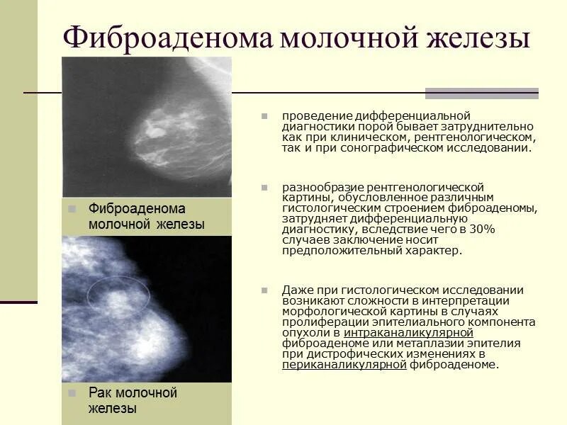 Распад опухоли молочной железы 4 стадия фото Образование молочных желез лечение