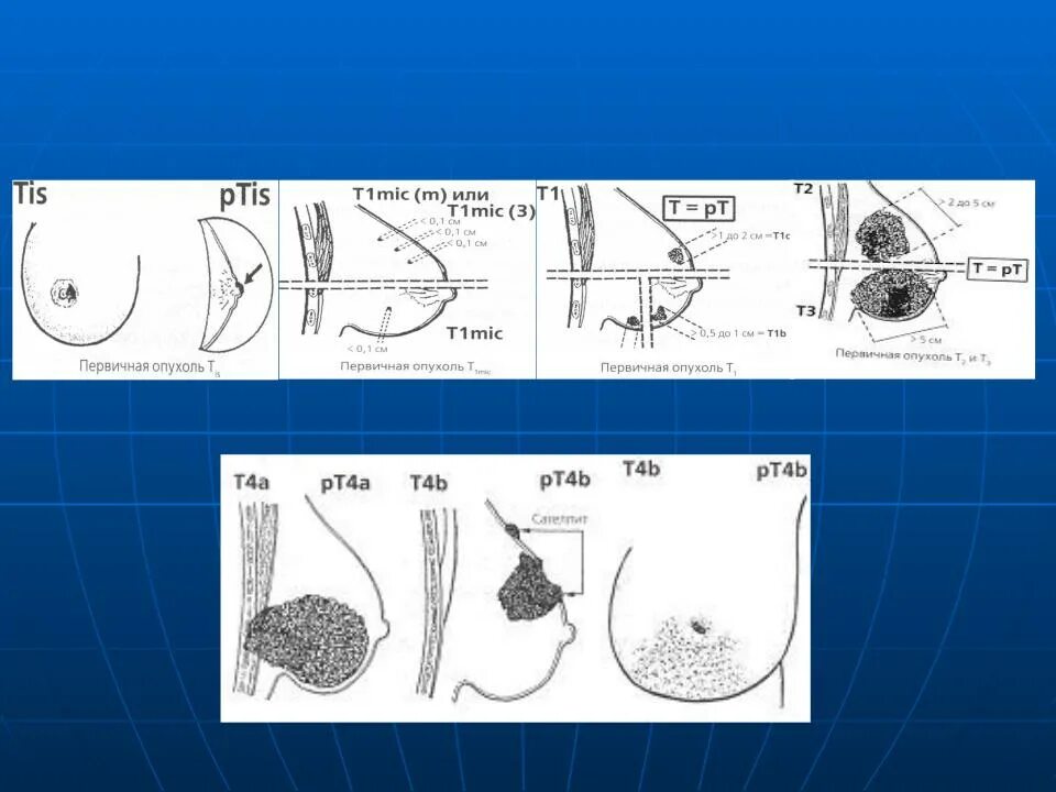 Распад опухоли молочной железы 4 стадия фото Презентация на тему: Предраковые заболевания