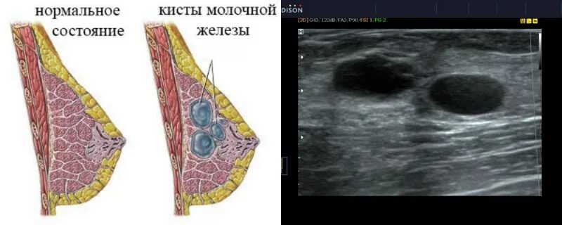 Распад опухоли молочной железы 4 стадия фото Фиброаденома как проходит операция - найдено 86 картинок