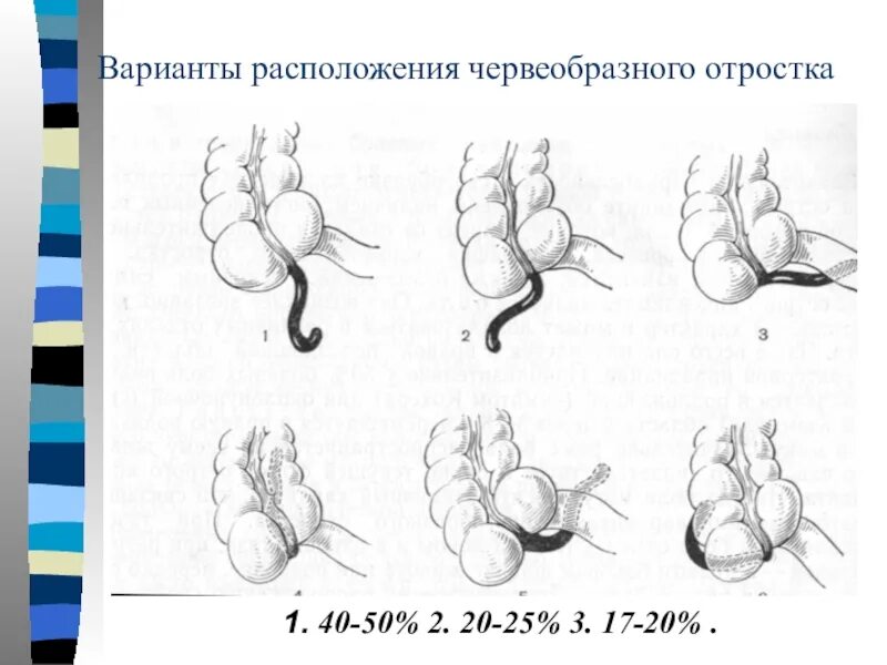 Расположение аппендицита у человека схема Классификация аппендицита - найдено 85 картинок