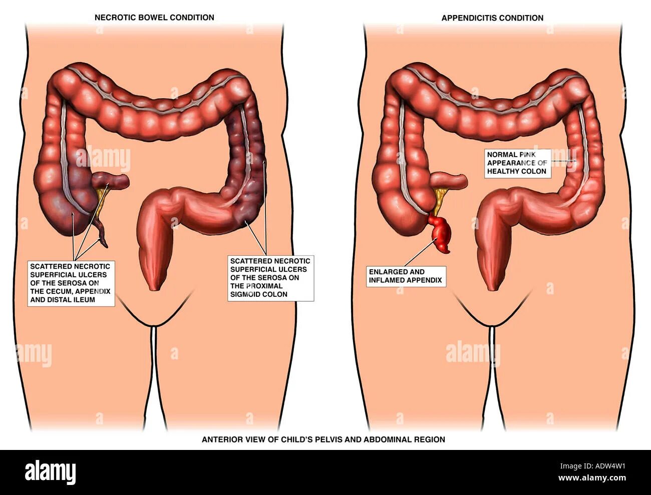 Расположение аппендицита у человека схема Exh4798b hi-res stock photography and images - Alamy