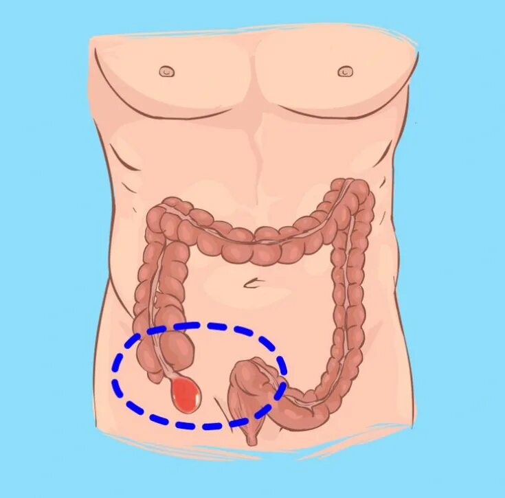 Расположение аппендицита у человека схема Чи існують способи запобігання запаленню апендикса - Estet-Portal