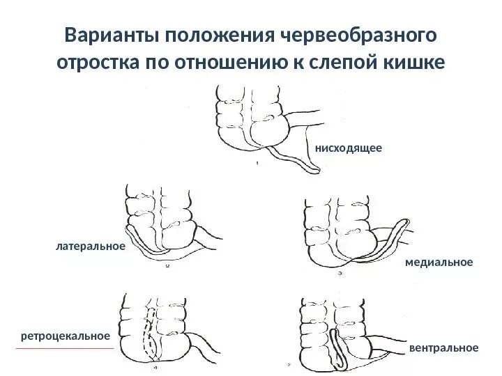 Расположение аппендицита у человека схема Аппендицит с какой стороны болит и колит