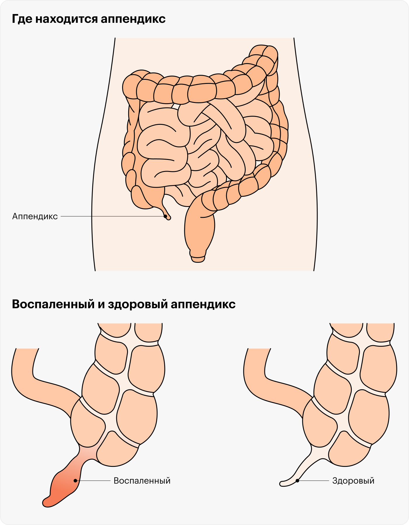 Аппендицит симптомы в домашних условиях у мужчин как определить