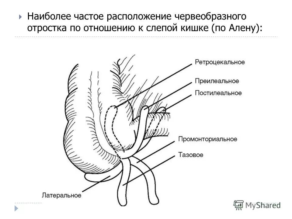 Расположение аппендицита у человека схема Ретроцекальный аппендицит: найдено 85 изображений