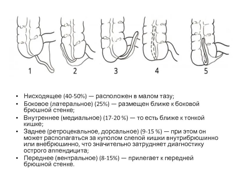 Расположение аппендицита у человека схема Аппендикса ретроцекальный