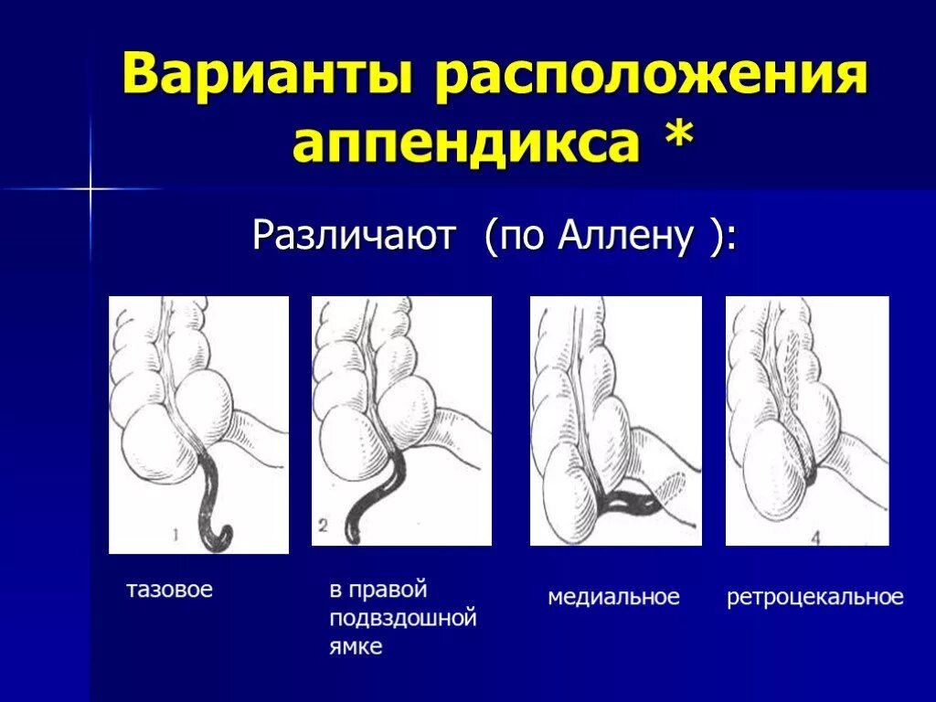 Расположение аппендицита у человека схема Презентация "Острый аппендицит" по медицине - скачать проект