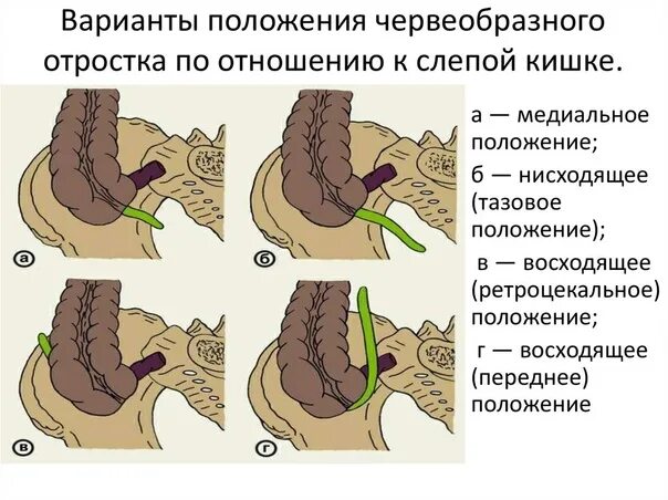 Расположение аппендицита у человека схема #госпитальная_хирургия_1_тема@otv6k Особенности клинической картины при атипично