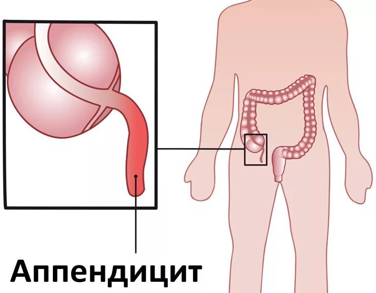 Расположение аппендицита у человека схема Аппендицит при беременности. Признаки аппендицита при беременности.