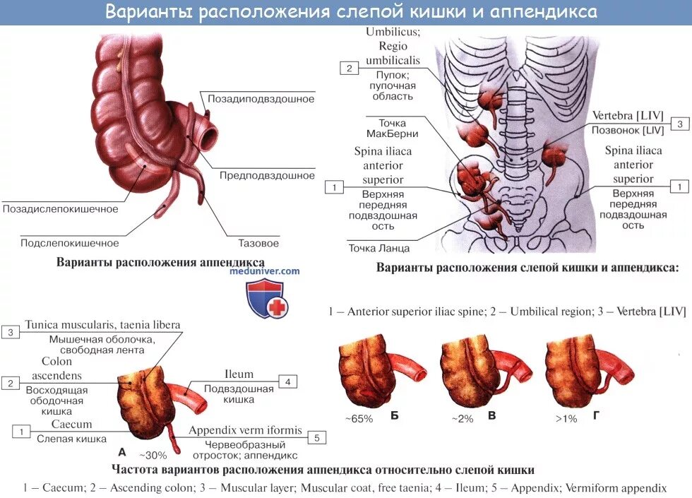 Расположение аппендицита у человека схема Анатомия человека: Слепая кишка. Червеобразный отросток ( апендикс, аппендикс ).