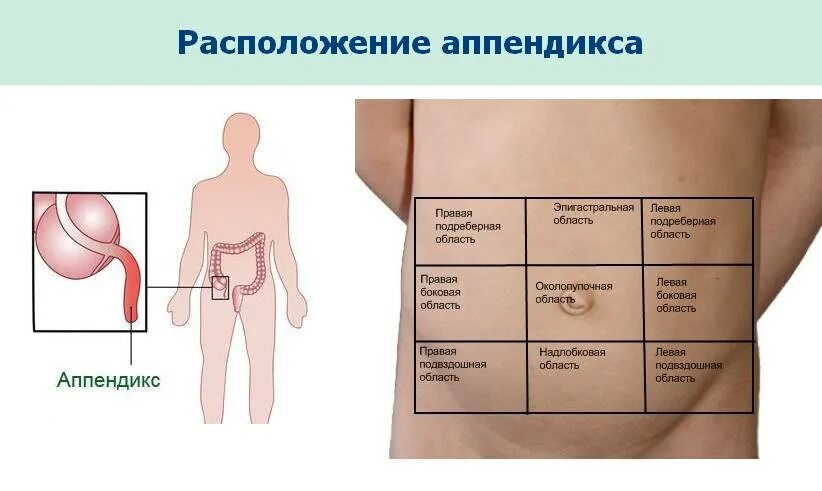 Расположение аппендицита у человека схема Аппендицит симптомы в домашних условиях у мужчин как определить