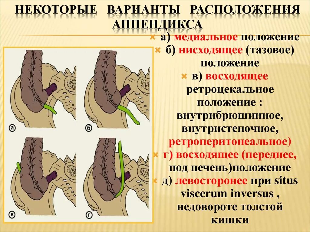 Расположение аппендицита у человека схема Острый аппендицит - презентация онлайн