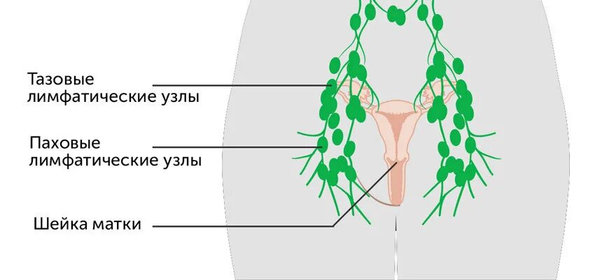 Расположение лимфоузлов в паху у женщин схема Тазовая лимфаденэктомия