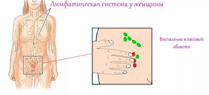 Расположение лимфоузлов в паху у женщин схема Увеличение паховых лимфоузлов - что может быть, если увеличились лимфоузлы в пах