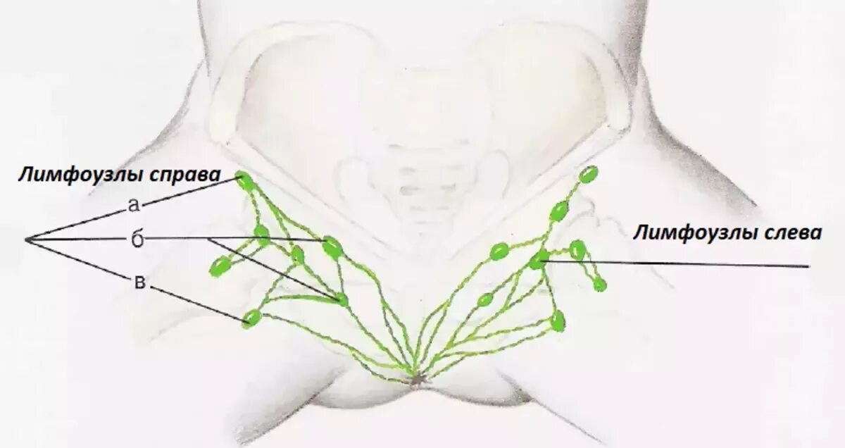 Расположение паховых лимфоузлов у женщин схема После удаления паховых лимфоузлов: найдено 25 изображений