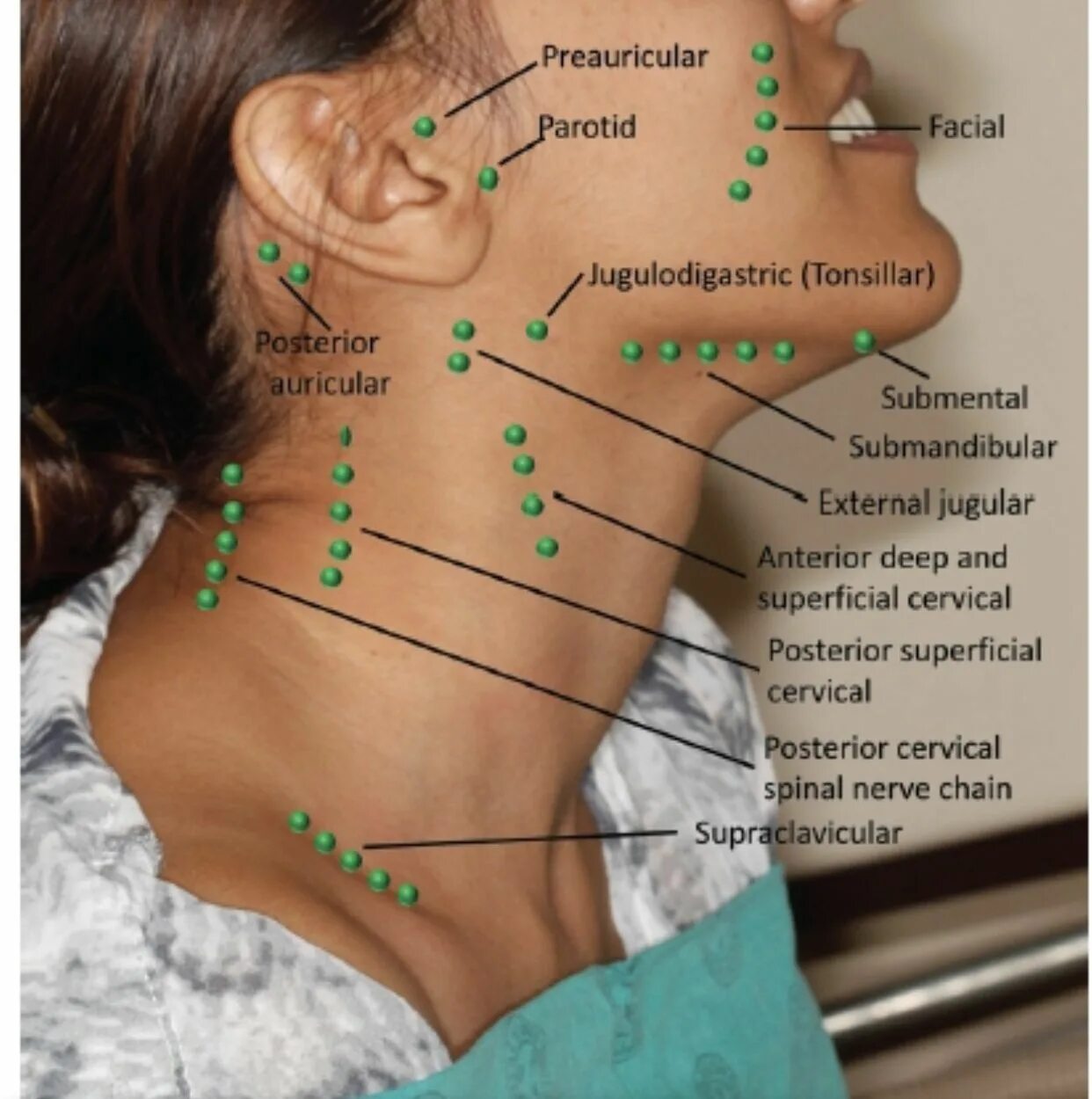 Расположение подчелюстных лимфоузлов у человека схема Pin on Medical Medical anatomy, Dentistry, Dental hygiene school