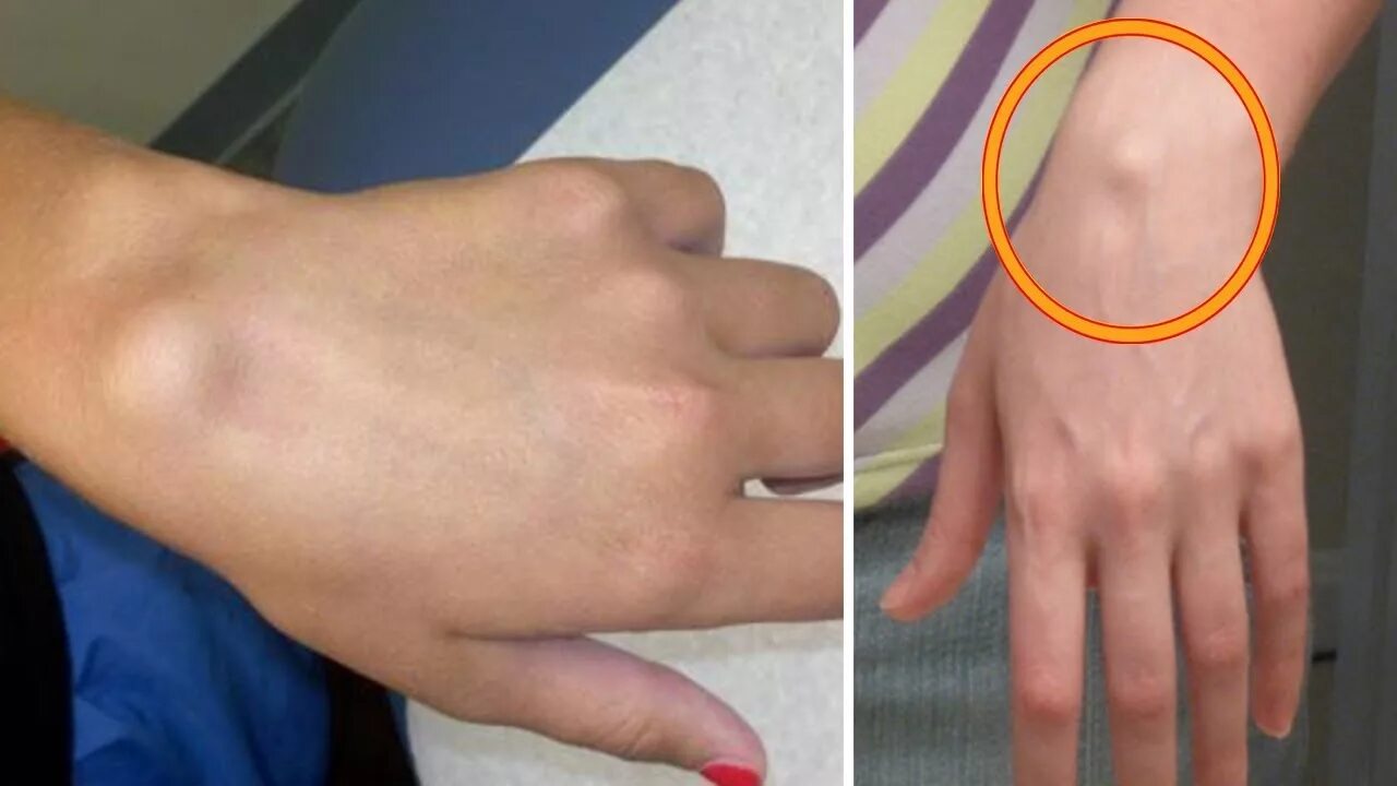 Распознать по фото укус A man found a strange lump on his palm and it turned out to be something heartbr