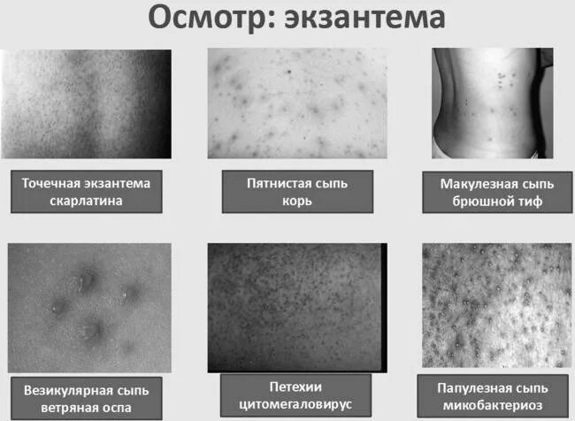 Распознать сыпь по фото Ветрянка карта вызова 03