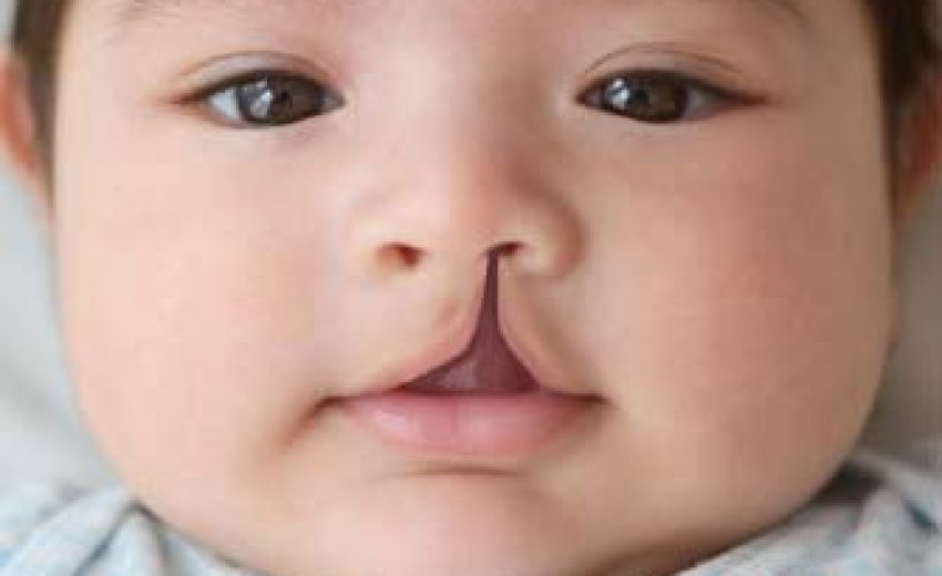 Расщелина губы и неба фото 100 operated on for cleft lip SikhNet