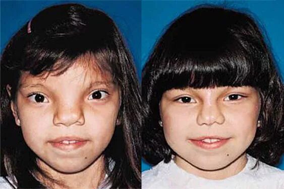 Cleft Lip Hellenic Craniofacial Center