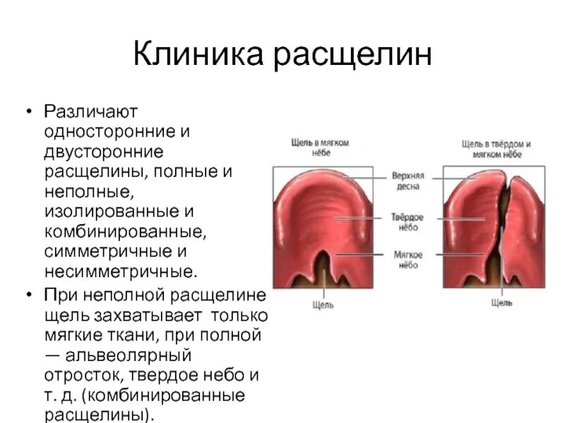 Расщелина мягкого и твердого неба фото Расщелина неба