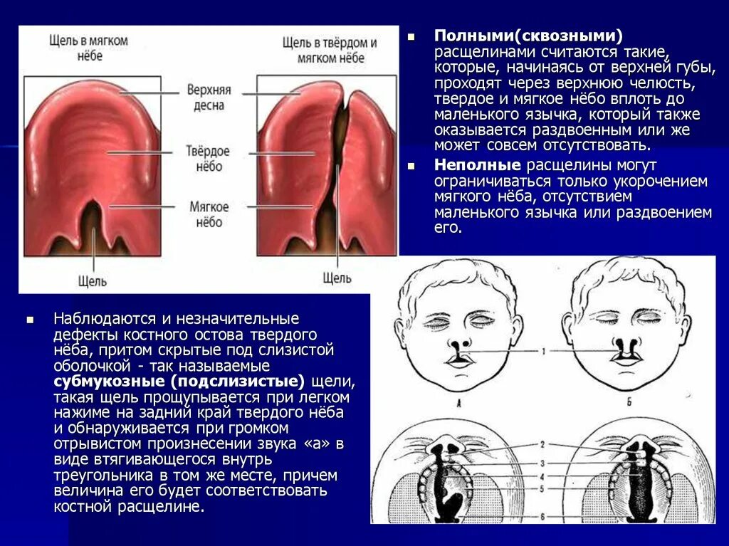 Расщелина мягкого и твердого неба фото Расщелина неба фото - ViktoriaFoto.ru